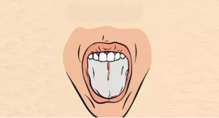 Kırmızı dil rengi bu hastalığın işareti! Doktorlar dilimize bu yüzden bakıyormuş