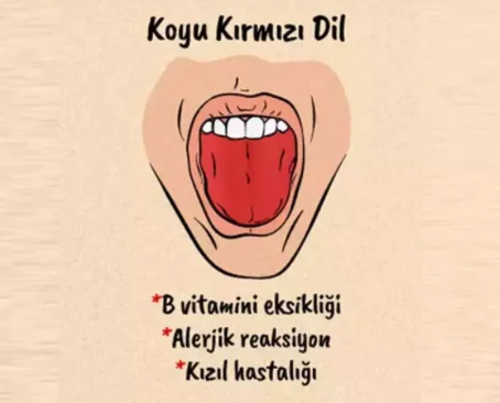 Kırmızı dil rengi bu hastalığın işareti! Doktorlar dilimize bu yüzden bakıyormuş
