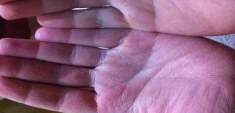 Aman Dikkat! Bu Belirti Şeker Hastası Olduğunuzu Gösteriyor muş?