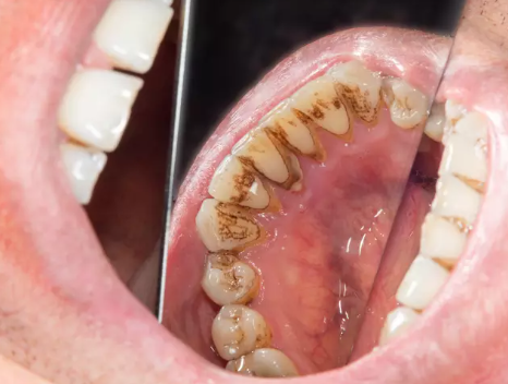 Bu Sayede Evde Diş Tartarlarınızı Yok Edin