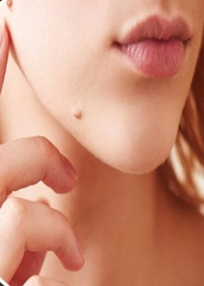 Yüzünüzdeki benlerin çoğalma nedeni ortaya çıktı.