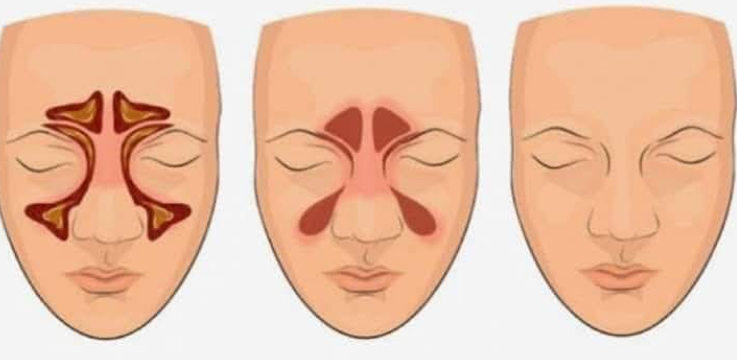 BURUN TIKANIKLIĞINA EN DOĞAL ÇÖZÜM