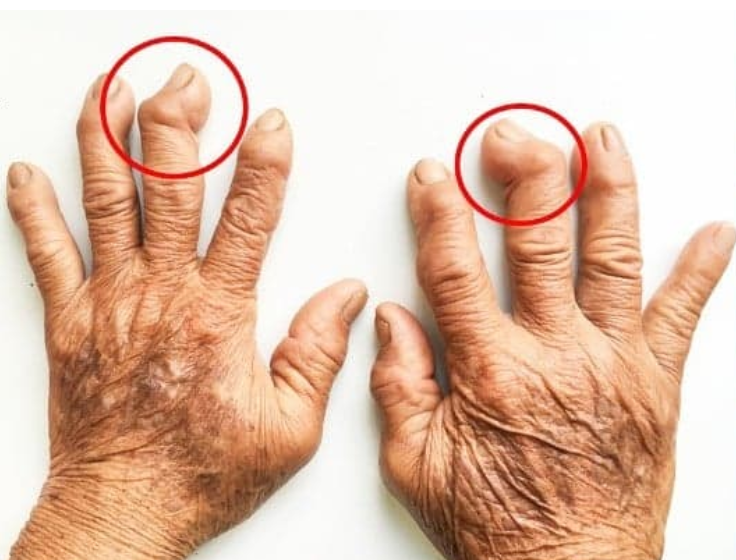 İltihaplı Eklem Romatizmasına Ne İyi Gelir, Nasıl Geçer?