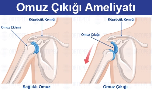Omuz Çıkığı: Belirtiler, Tedavi Yöntemleri ve Ameliyat Süreci